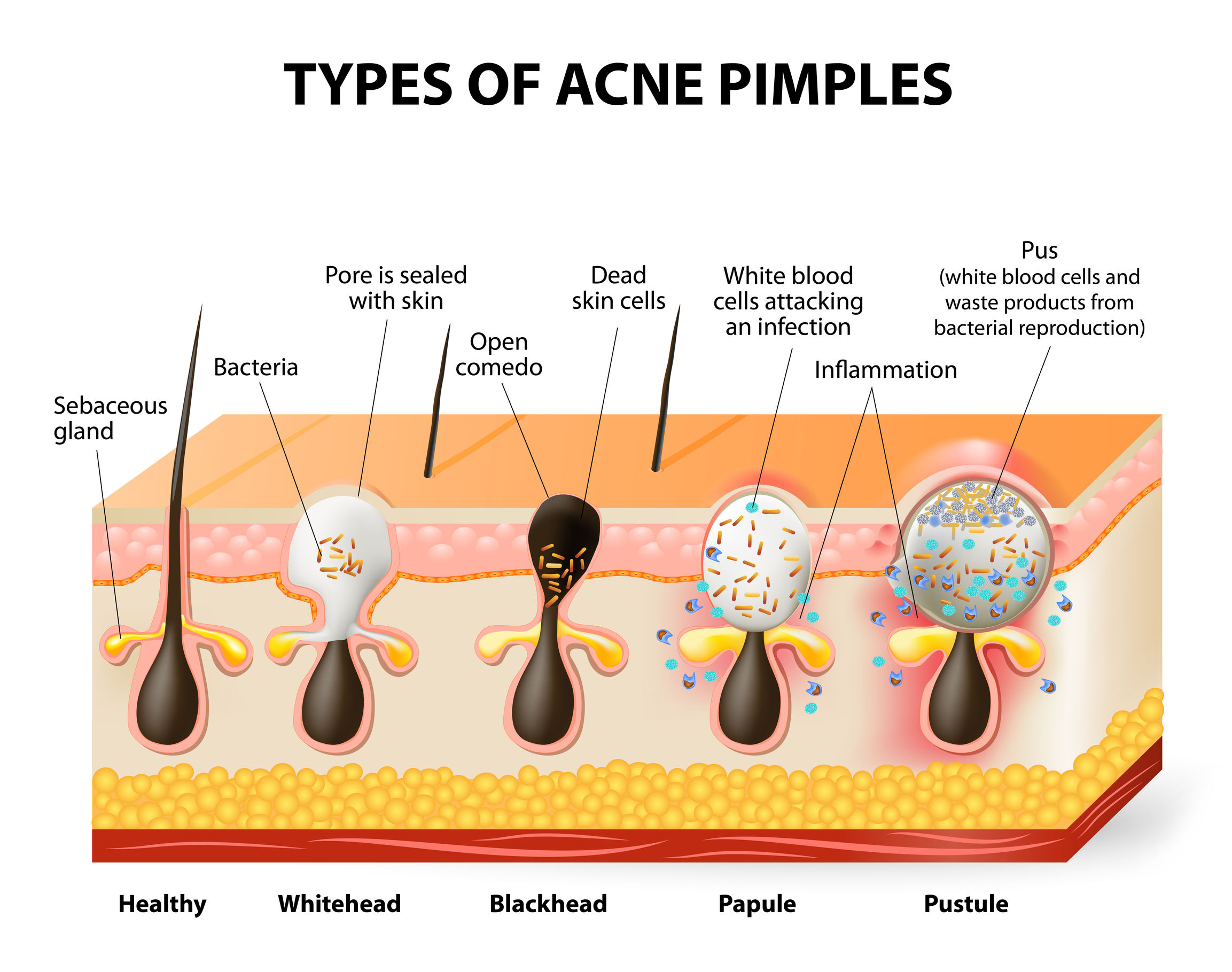 mild cystic acne diagram